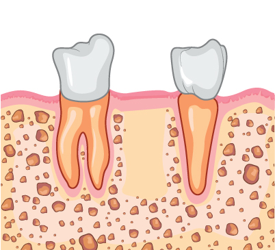 보험 임플란트 치료과정 01