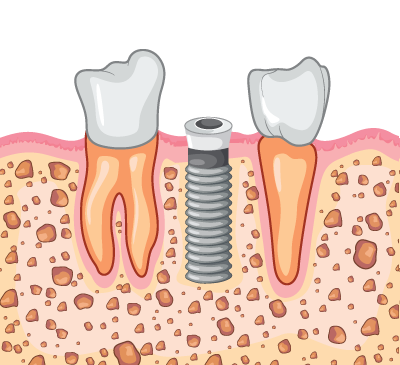 보험 임플란트 치료과정 02