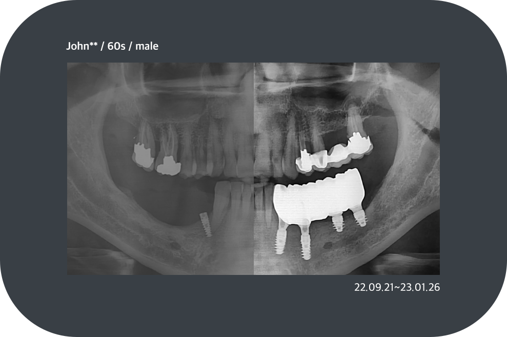 implant_case05