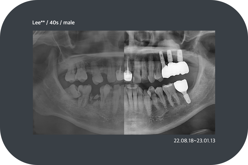 implant_case09