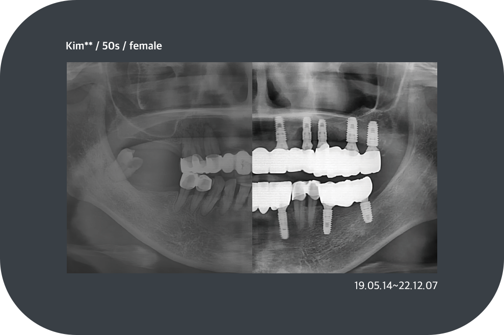 implant_case11