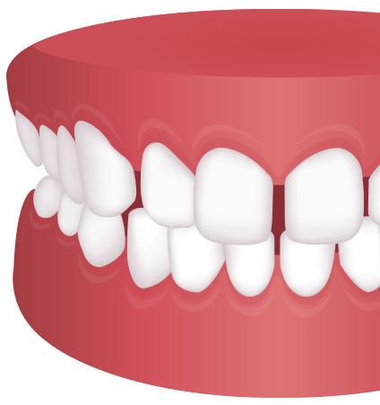 치아 사이 공간모형